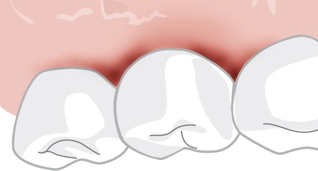 Grafik: Zähne und gerötetes Zahnfleisch